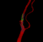 Stent Carotid Stenosis II